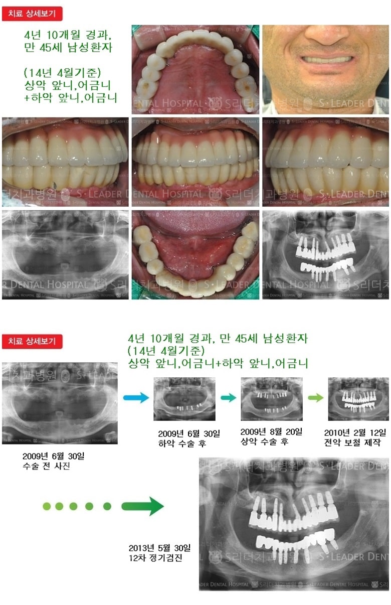 상악 전체, 하악전체,17년 3개월 경과 — 추가 사진 (임플란트)