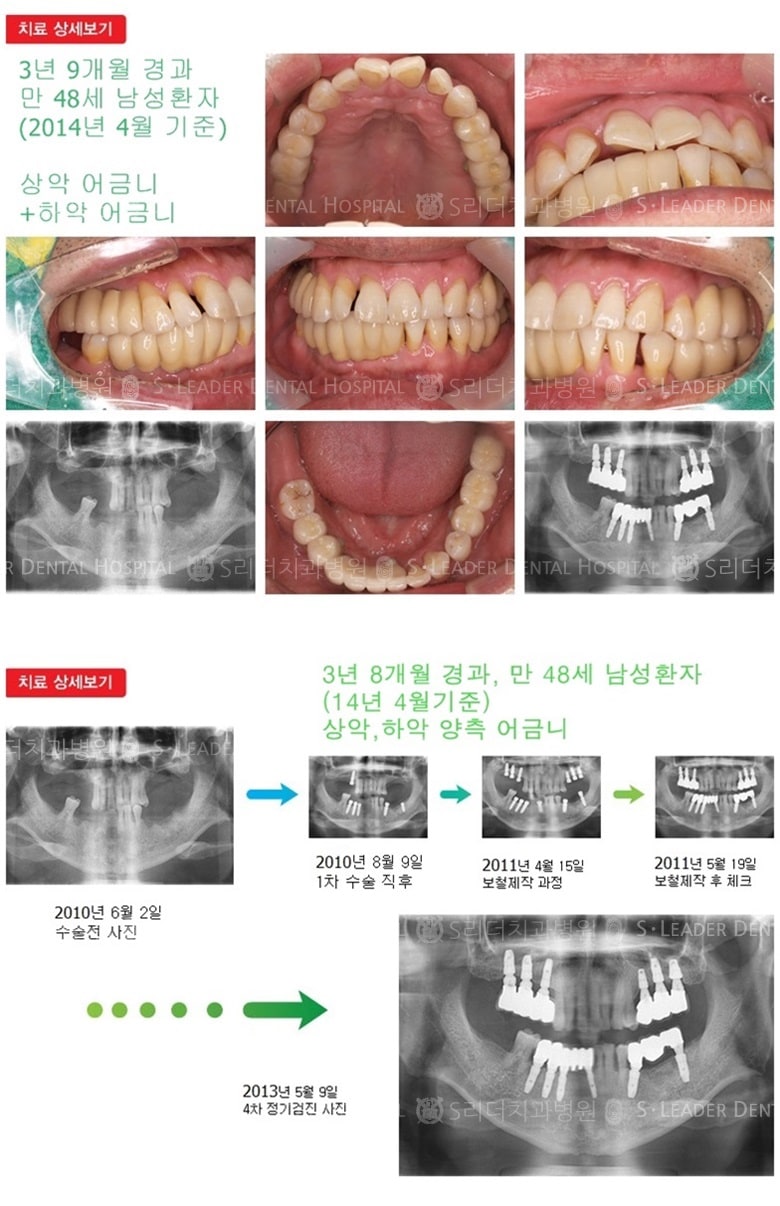 상악어금니,하악어금니,16년 1개월경과 — 추가 사진 (임플란트)