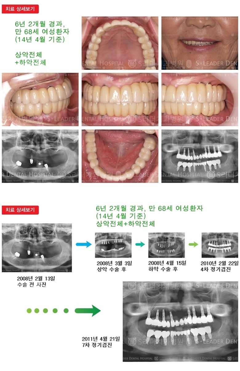 상악전체,하악전체,18년 7개월경과 — 추가 사진 (임플란트)