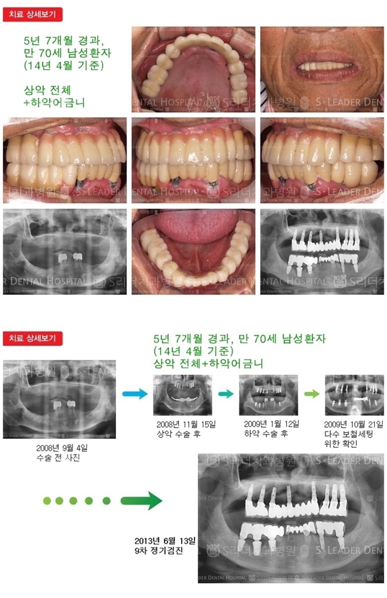 상악전체,하악어금니,18년경과 — 추가 사진 (임플란트)