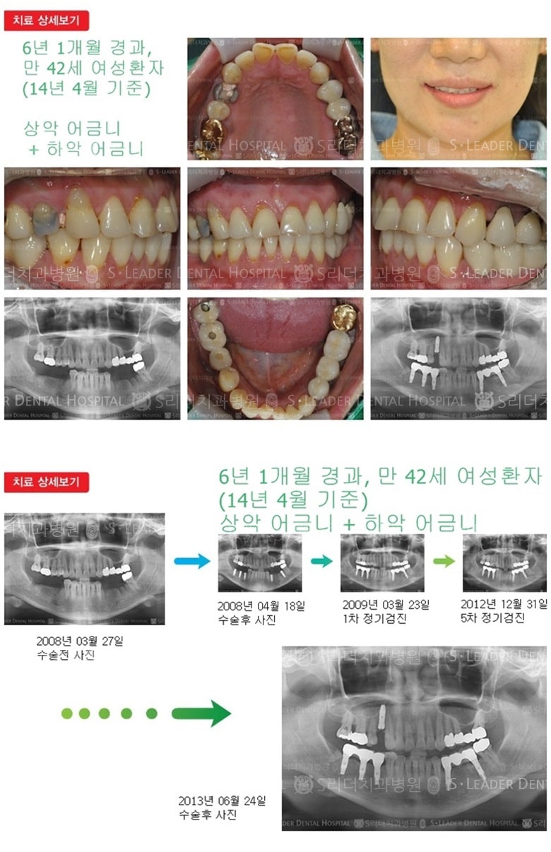 상악어금니,하악어금니,18년 6개월 경과 — 추가 사진 (임플란트)