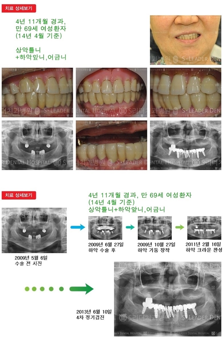 상악전체,하악전체,17년 4개월경과 — 추가 사진 (임플란트)
