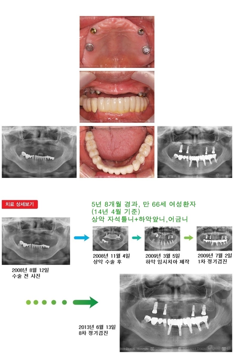 상악전체,하악전체,18년 1개월경과 — 추가 사진 (임플란트)