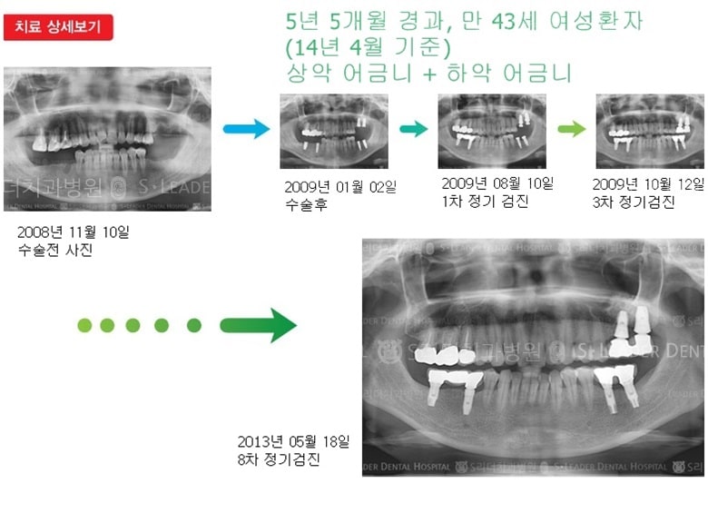 상악어금니,하악어금니,17년 10개월 경과 — 추가 사진 (임플란트)