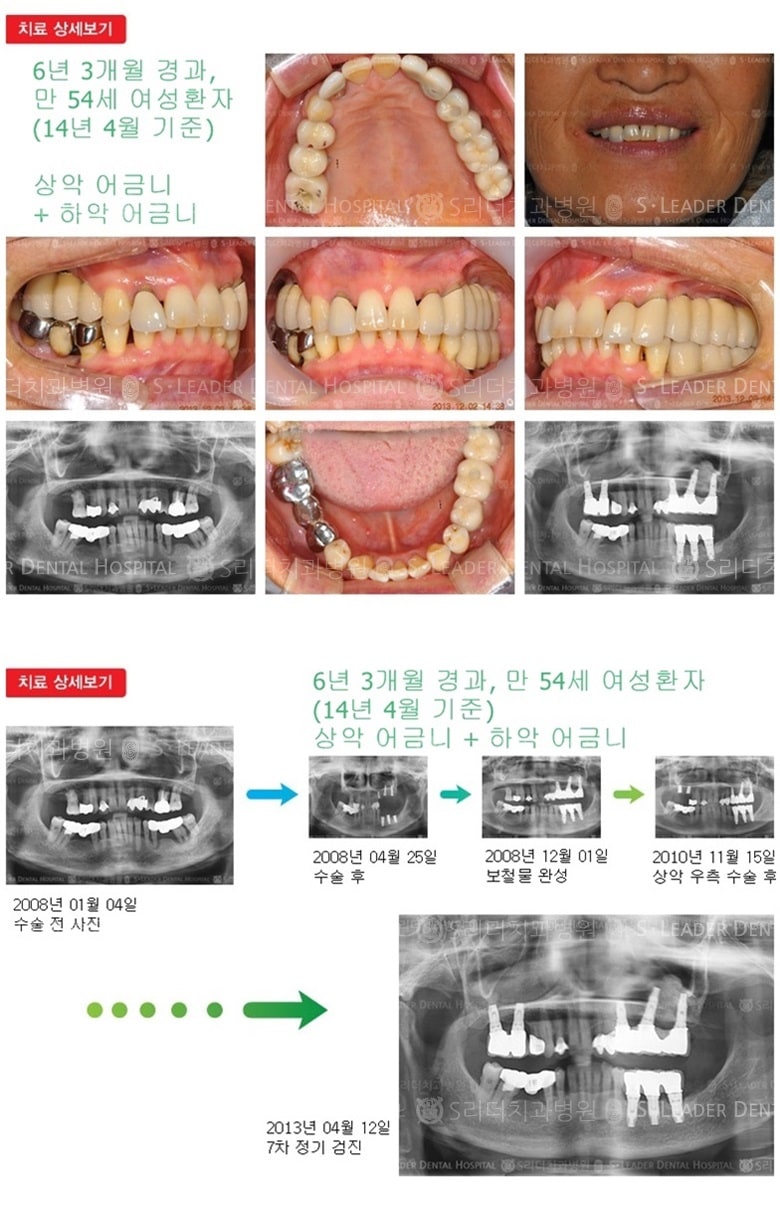 상악어금니,하악어금니, 18년 8개월 경과 — 추가 사진 (임플란트)