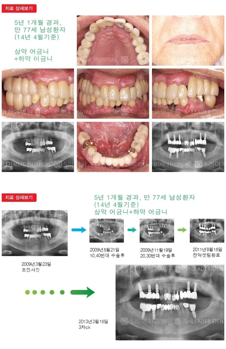 상악 어금니, 하악 어금니,17년 6개월 경과 — 추가 사진 (임플란트)