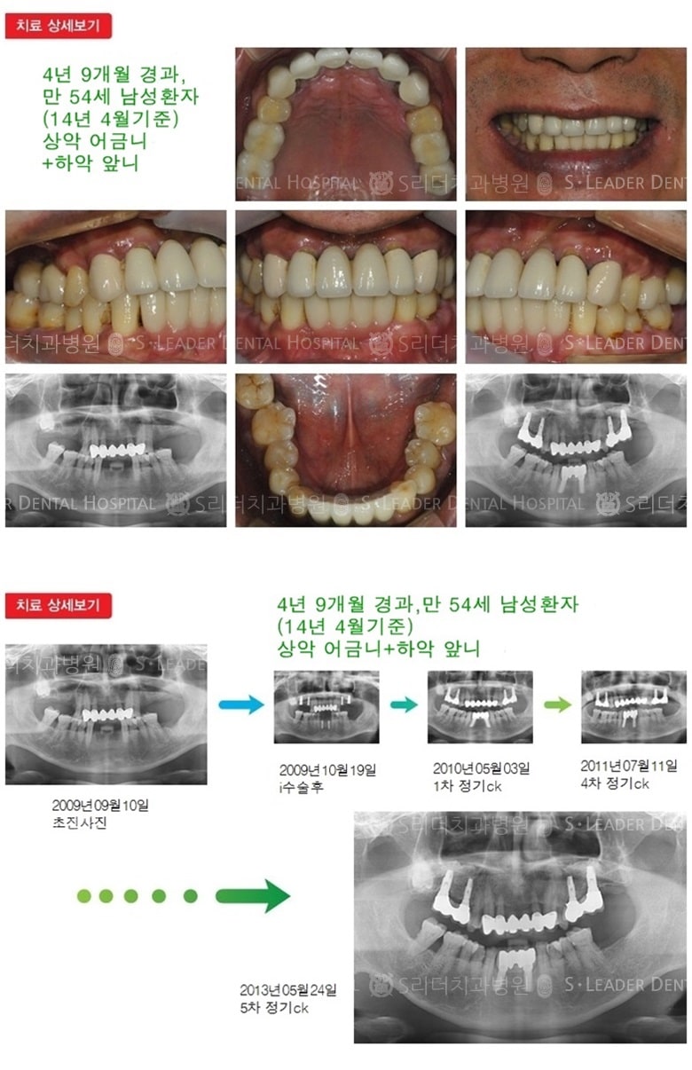 상악 어금니, 하악 앞니. 17년 2개월 경과 — 추가 사진 (임플란트)