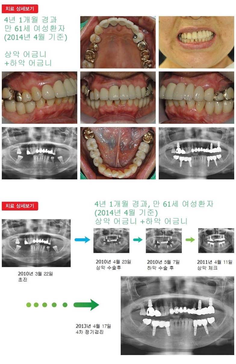 상악어금니,하악어금니,16년 6개월 경과 — 추가 사진 (임플란트)