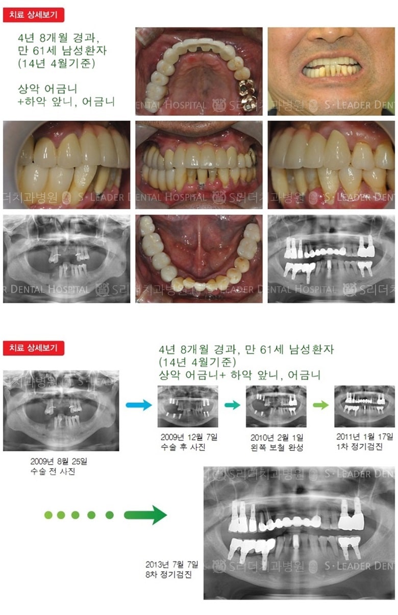 어금니임플란트,앞니임플란트,17년경과 — 추가 사진 (임플란트)