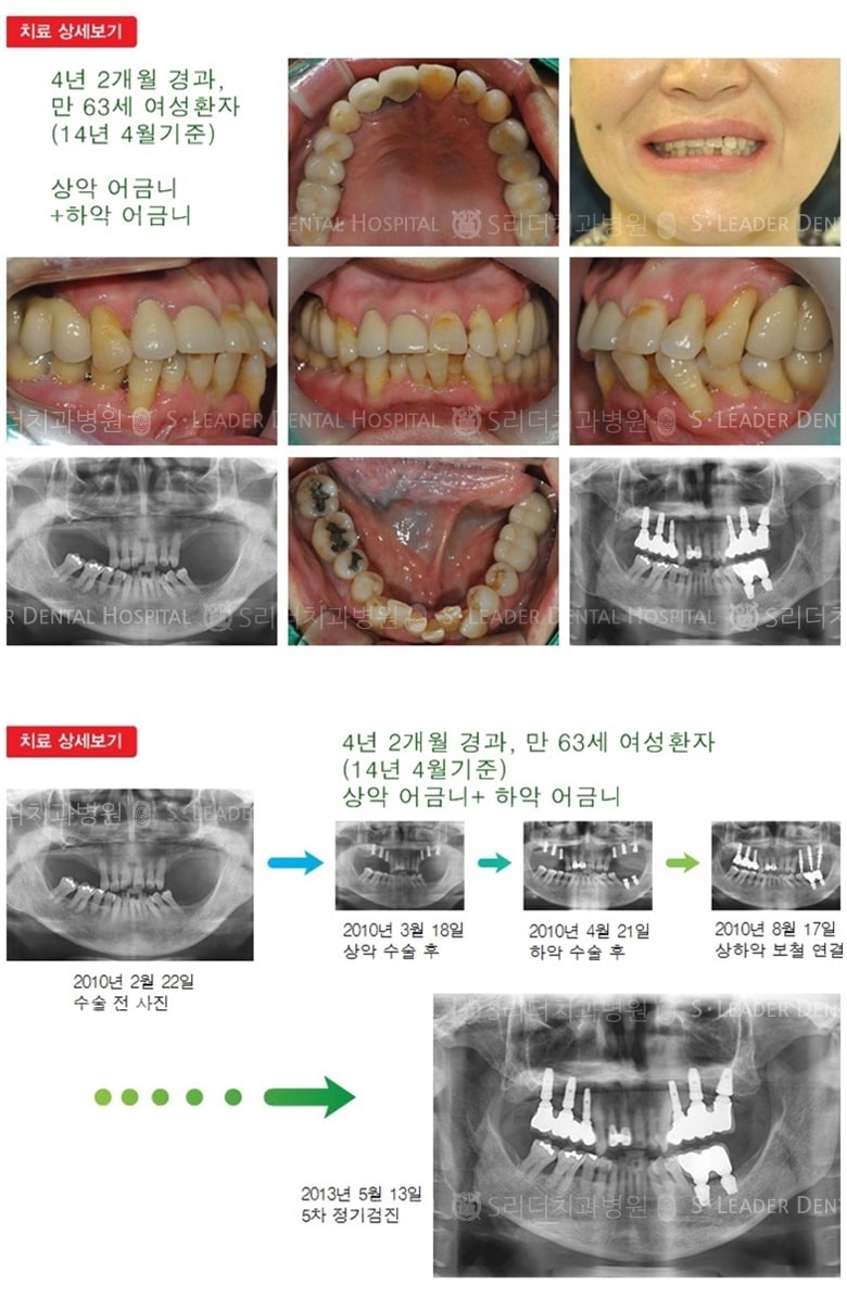 어금니임플란트, 16년 6개월 경과 — 추가 사진 (임플란트)