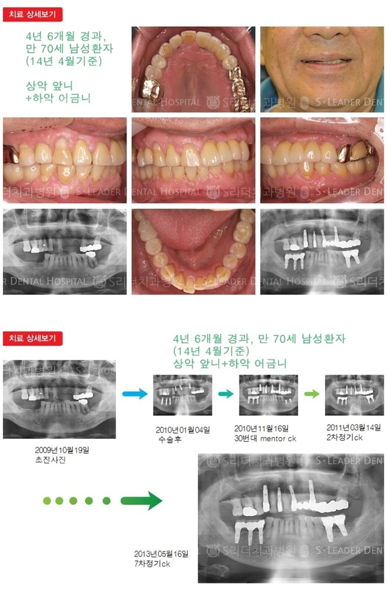 노인임플란트, 만70세, 16년 10개월 경과 — 추가 사진 (임플란트)