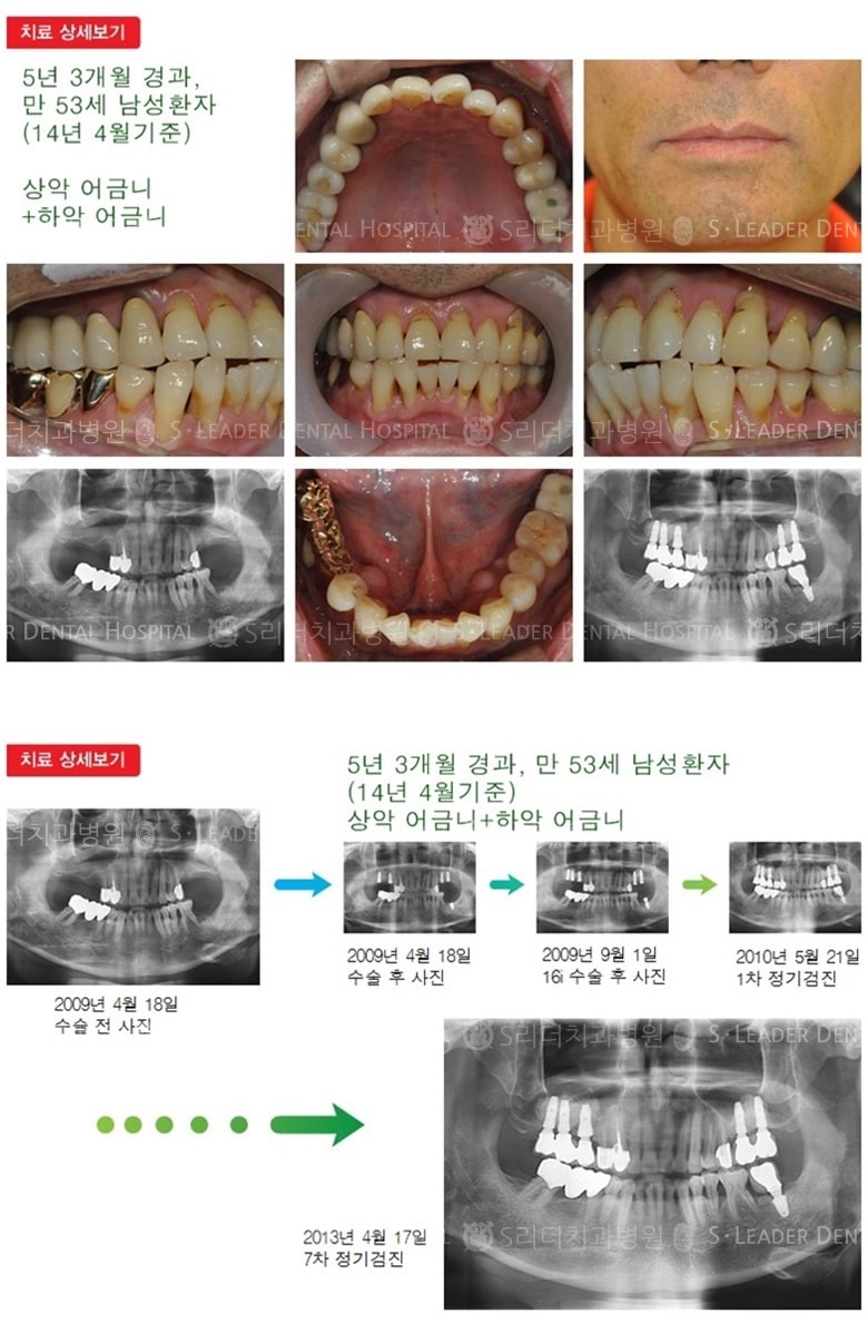 어금니임플란트, 17년 7개월 경과 — 추가 사진 (임플란트)