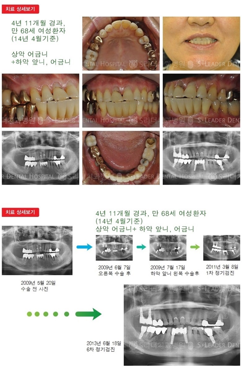 상악 어금니,하악 앞니,어금니17년 3개월경과 — 추가 사진 (임플란트)
