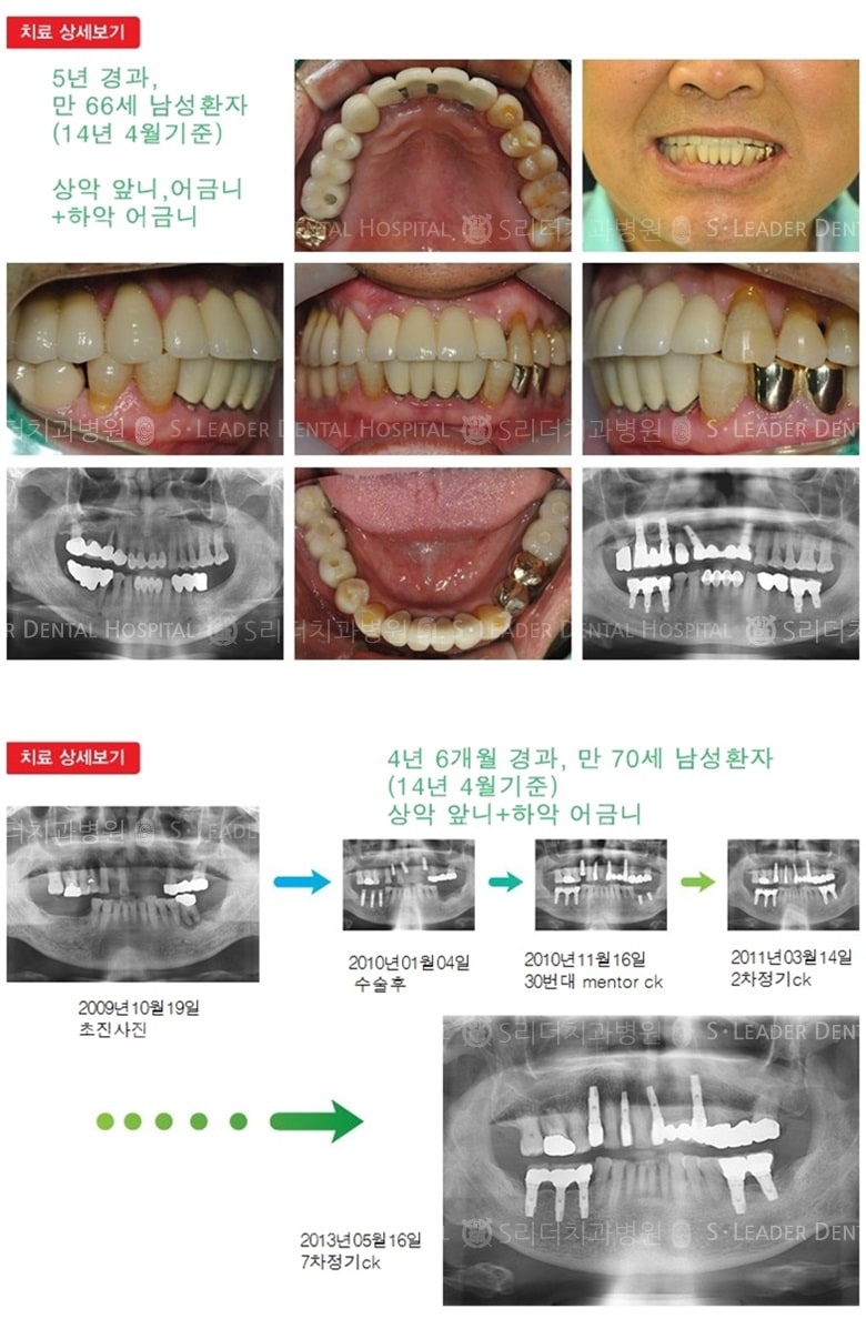 어금니임플란트, 앞니임플란트, 17년 4개월 경과 — 추가 사진 (임플란트)